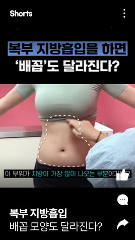 복부 지방흡입하면 배꼽도 달라진다?