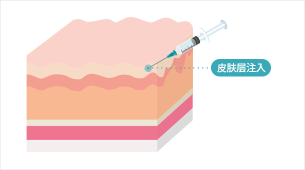 将肉毒素注入皮肤层, 而非肌肉, 具有改善细纹, 肤质, 缩小毛孔, 红斑等多种效果