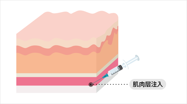 普通肉毒素