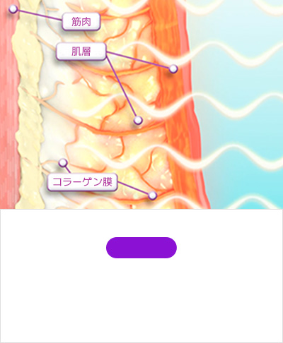 STEP 02 サーマジFLXで 高周波エネルギーを真皮に伝達