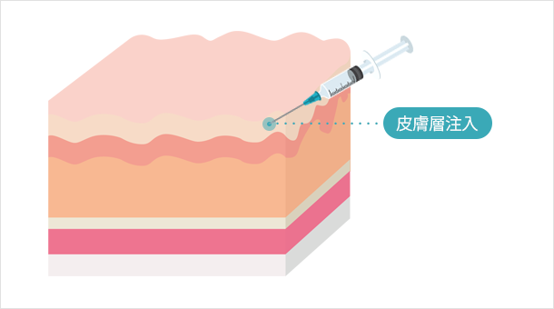 スキンボトックス