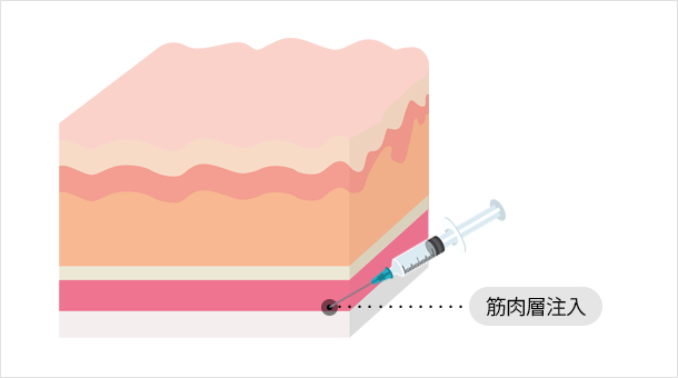 一般ボトックス