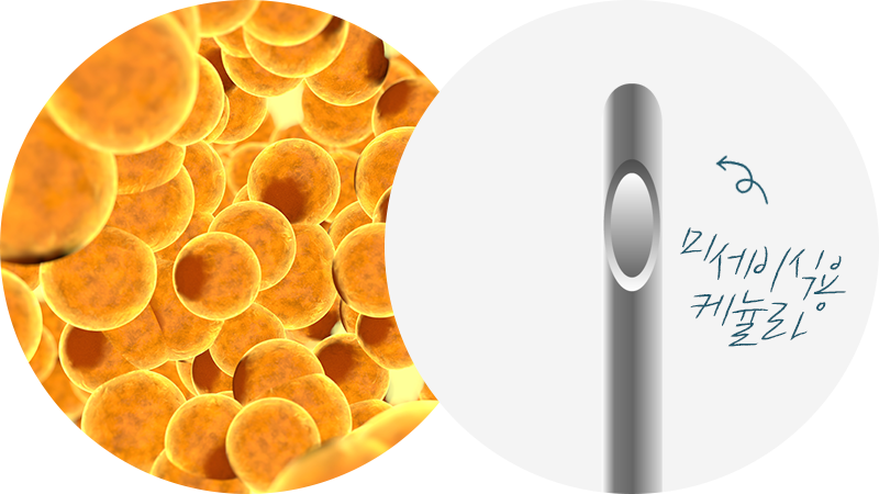 과도하게 지방을 한 부위에 주입 시 생착율이 떨어 질 수 있습니다. 세이예스는 섬세하고 고르게 주입하고 생착율을 높입니다.