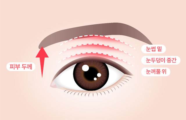 세이예스 상안검 세이예스는 피부두께와 처짐 정도를 정확히 파악하여 미적인 부분과 기능적인 부분 모두 개선 할 수 있는 수술법을 적용