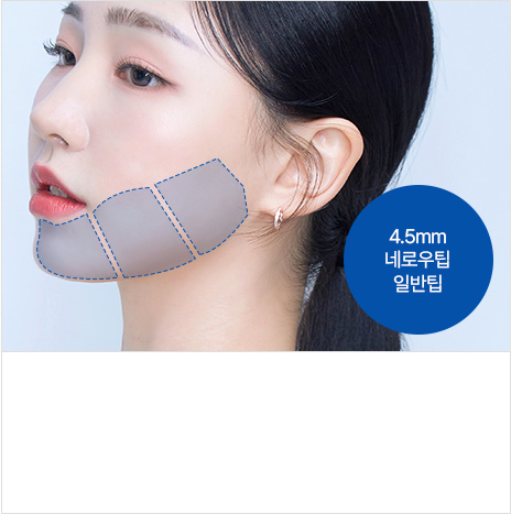 4.5mm 네로우팁 일반팁 근막층리프팅부위 : 탄력을 잃은 턱선, 얼굴 라인