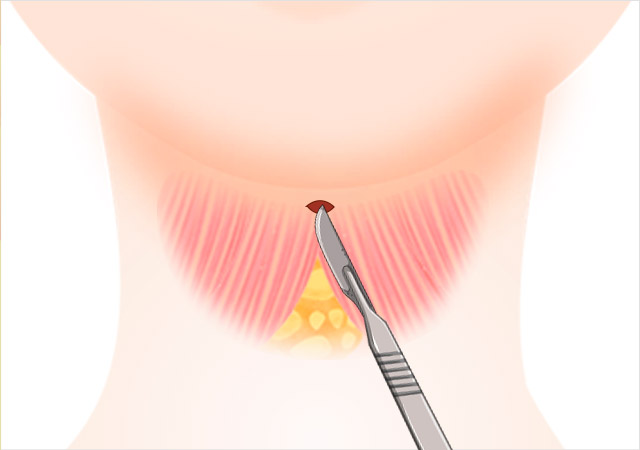 STEP 02 활경근(목근육)을 절개합니다.