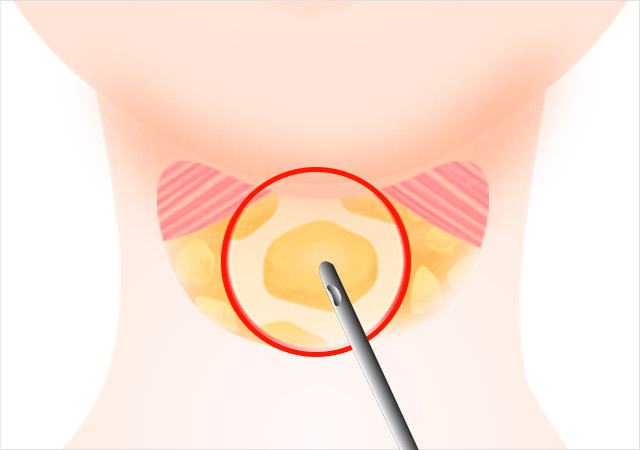 STEP 03 절개된 활경근(목근육)의 아래 지방을 제거합니다.