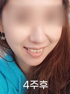 울쎄라 리프팅 전후사진