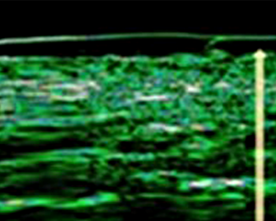 시술 후 7개월 (진피층 두께 27%증가)