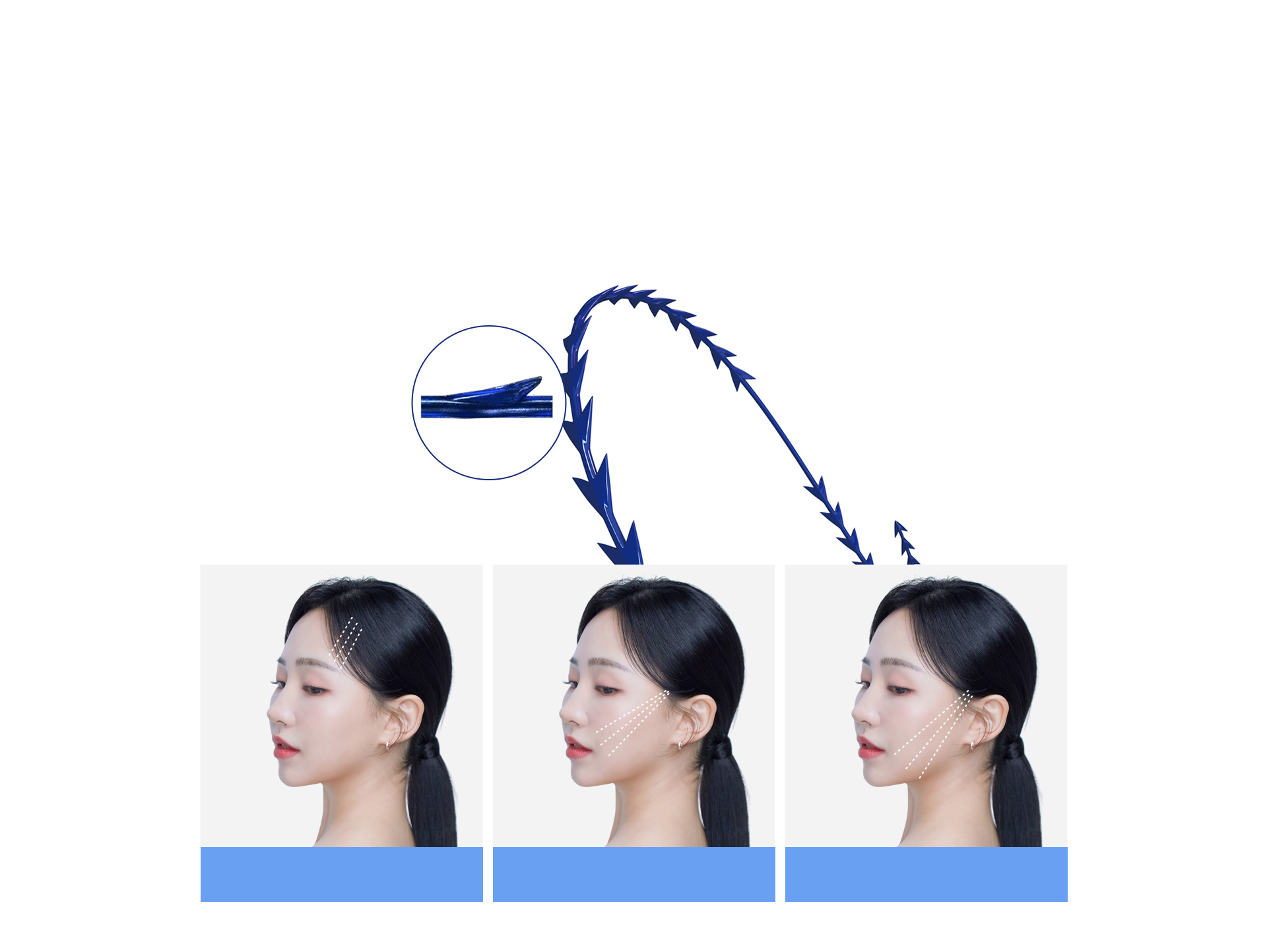 특수 몰딩으로 어느 부위든 강력하게 특수 몰딩 기법으로 더 크고 강해진 돌기가 피부를 강력하게 당겨주고, 더욱 강력하게 고정합니다.