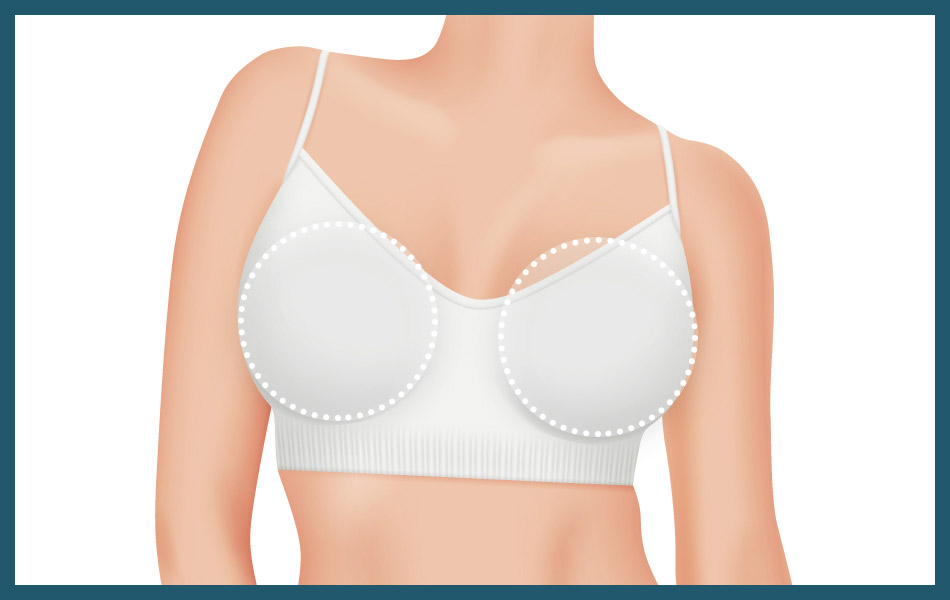 Full breast augmentation