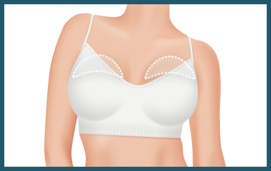 Upper breast augmentation