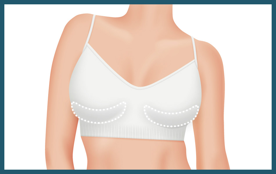 Lower breast augmentation