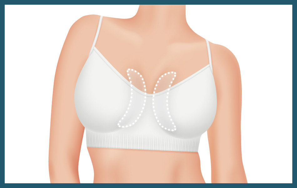 Inner breast augmentation