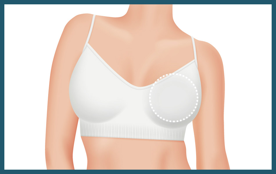 Correction of breast asymmetry