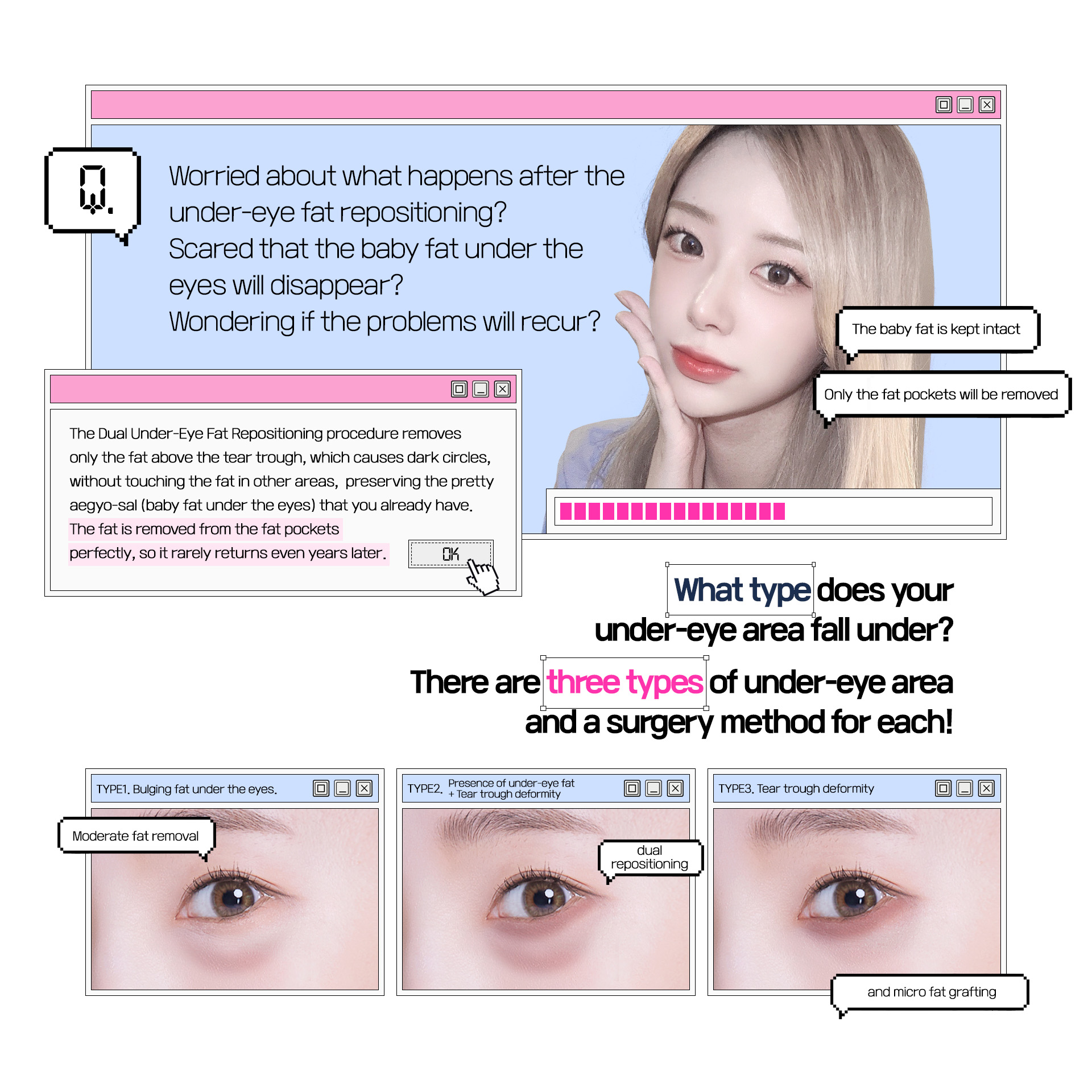 듀얼Under-eye Fat Repositioning는 다른 부위의 지방은 건드리지 않고 다크써클의 원인이 되는 눈물 고랑 위쪽의 지방만 제거하여 내가 가지고 있는 예쁜 애교살은 보존합니다. 완벽한 지방주머니의 지방제거로 몇 년이 지나도 재발하는 일은 거의 없습니다.