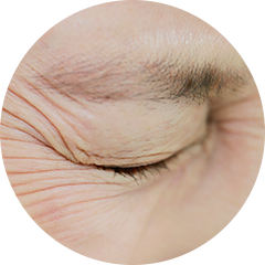 2 the under-eye area sagging with wrinkles 