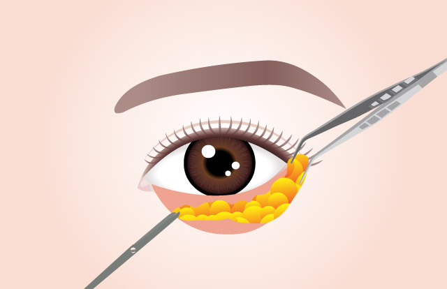 STEP 01 Fat is removed and repositioned through the transconjunctival membrane.