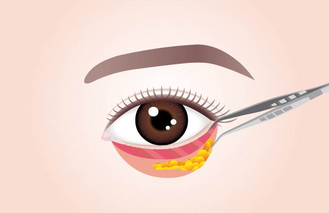 STEP 02 Fat is repositioned under the muscle in the depressed tear trough.