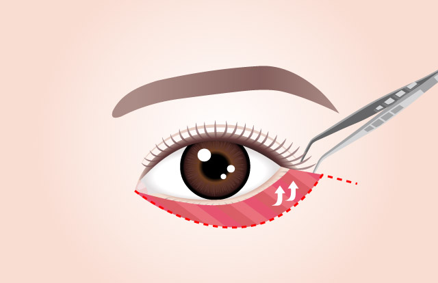 STEP 02 Sagging skin and muscles are pulled up and fixed in place.