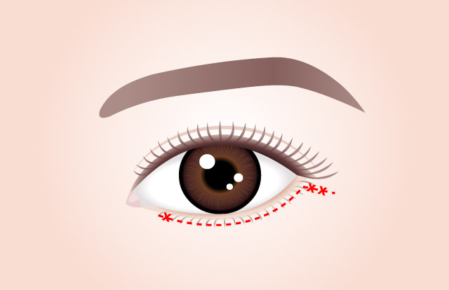 POINT 01 Microincision just below the eyelashes for barely visible scars