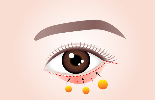 POINT 02 Fixed to the angulus oculi lateralis (lateral angle of the eye) to prevent recurrence