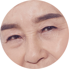 1 excessive drooping of the eyelids  due to aging