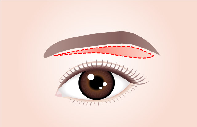 STEP 01 An incision is made right below the brow