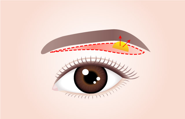 STEP 02 Excess skin and muscle are removed and the remaining skin and muscle are attached to the periosteum