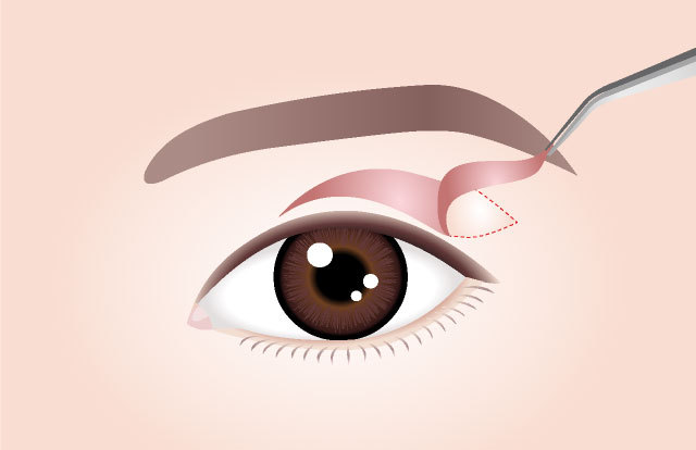 Conventional Brow Lift Simply excise excess skin and pull up the remaining sagging skin Increased risk of recurrence