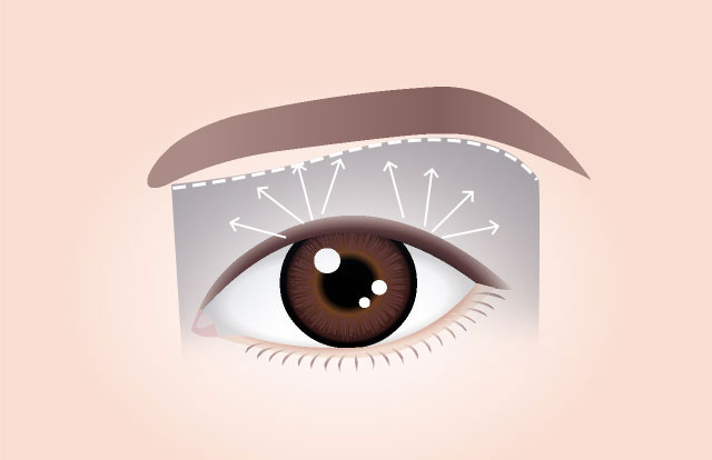 Conventional Brow Lift The result may appear a bit awkward if the doctor simply removes excess skin and pull up the remaining skin without accurately determining the skin thickness and the degree of sagging