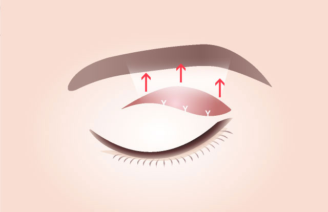 STEP 03 Tightening of Facial Expression Muscles The stretched muscles are cut to remove excess tissue, and the remaining muscles are attached to the conjunctiva.