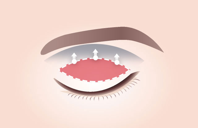 SAYYES Upper Blepharoplasty Corrects the appearance by pulling up the orbicularis oculi muscle, not just the skin, to reduce the chance of recurrence