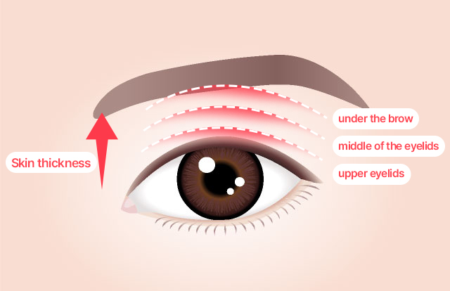 SAYYES Upper Blepharoplasty At SAYYES, we accurately assess the skin thickness and the degree of sagging and apply a surgical method that can improve both the aesthetic and functional aspects