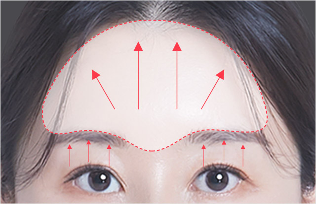 Solution for forehead wrinkles, frown lines, wrinkles around the eyes, brow wrinkles, and sagging eyebrows