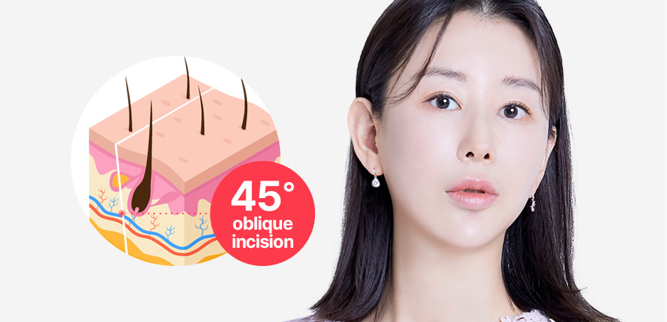 45˚ oblique incision: The incision is made diagonally, avoiding the hair roots to prevent hair loss and damage to the hair roots.