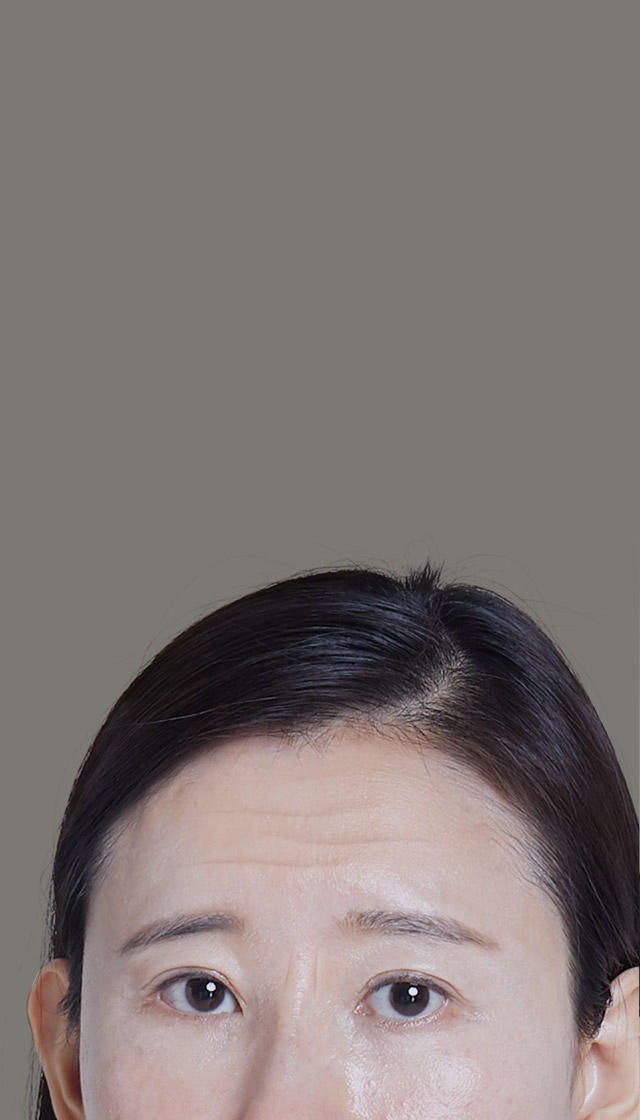 Depressed look and signs of aging + Droopy eyes + Droopy eyebrows + Frown lines + Forehead wrinkles The problems can be addressed all at once with Endoscopic Forehead Lift