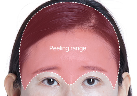 STEP 01 Design We devise a surgery plan and design the upper eyelids according to the individual's aging condition, direction of wrinkles, and the degree of skin sagging. 