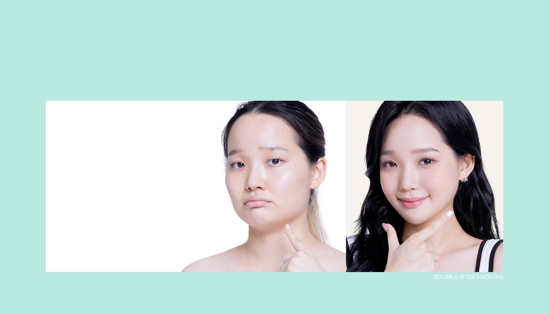 뼈를 깍지않고 완성하는 라인Accu V Facial Reduction &Fat Removal