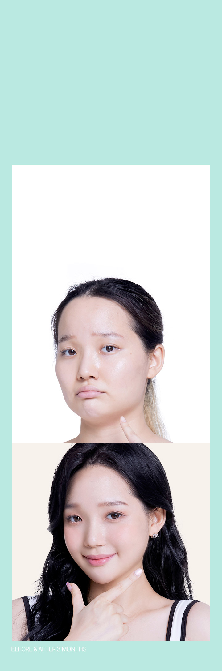 뼈를 깍지않고 완성하는 라인Accu V Facial Reduction &Fat Removal