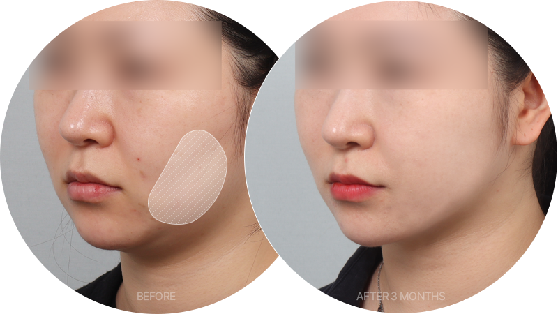 cheeks There’s a way of removing excess cheek fat without making the skin look lumpy afterwards?