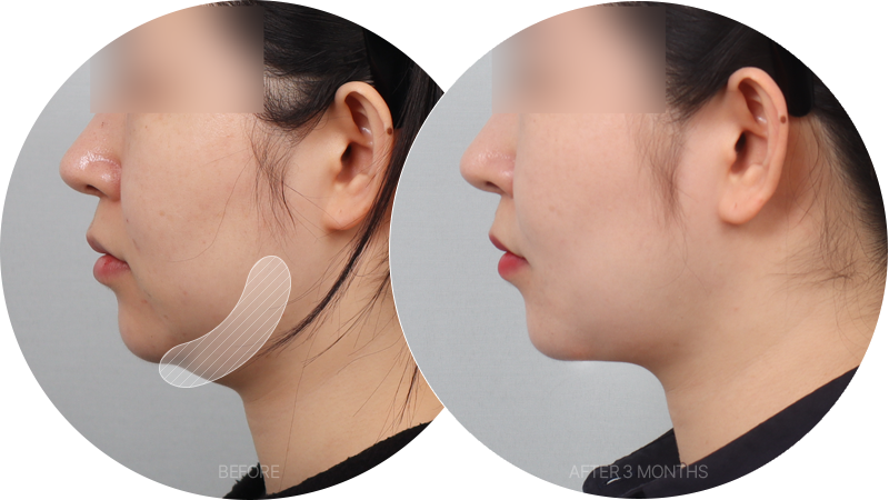 Slim down the jawline without any sagging skin!