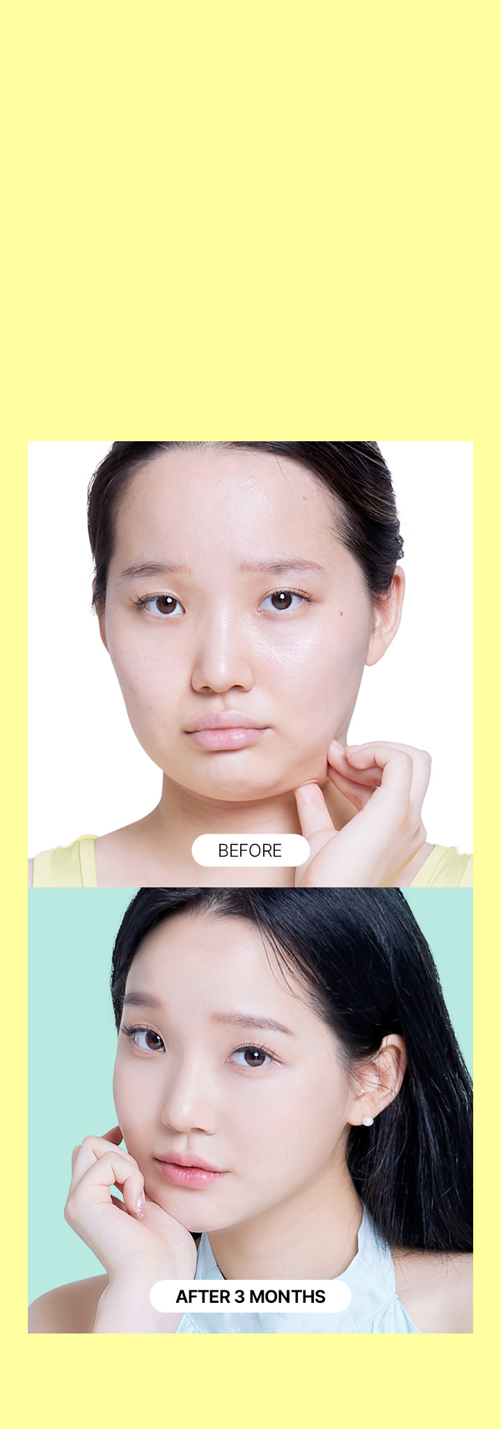 SAYYES Large-Volume Facial Reduction & Liposuction Procedure For facial liposculpture,special techniques are applied to prevent sagging and nerve damage, while removing as much fat as possible to maximize the effect of the facial reduction procedure