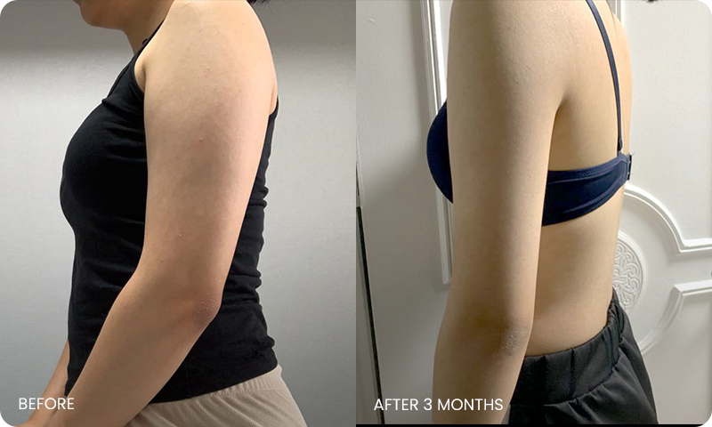 I-line arm liposuction bna