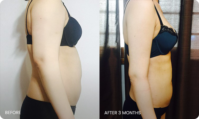 I-line arm liposuction bna