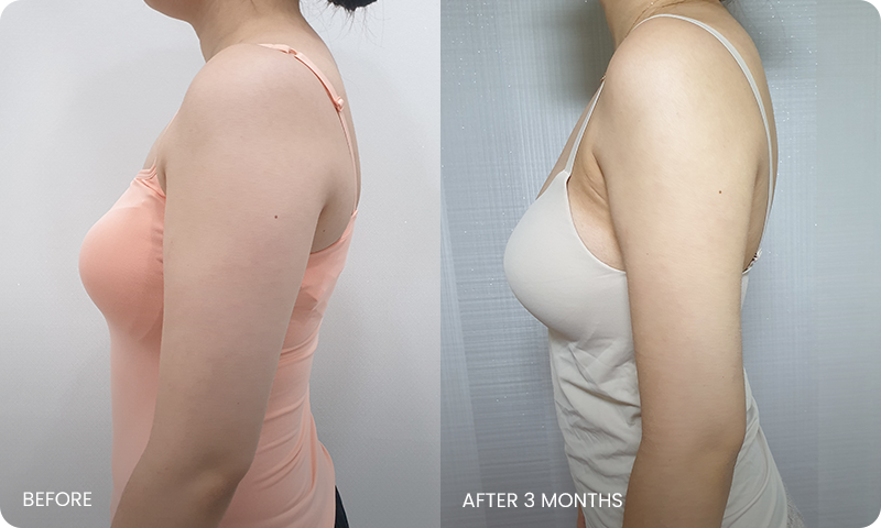 I-line arm liposuction bna