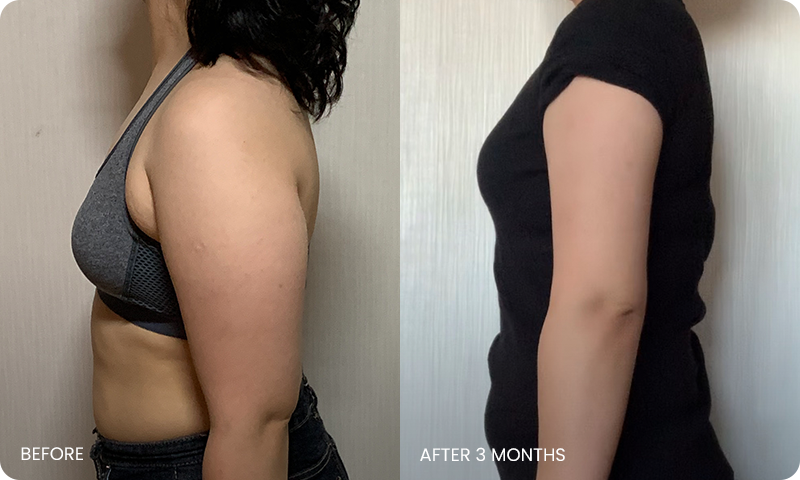 I-line arm liposuction bna