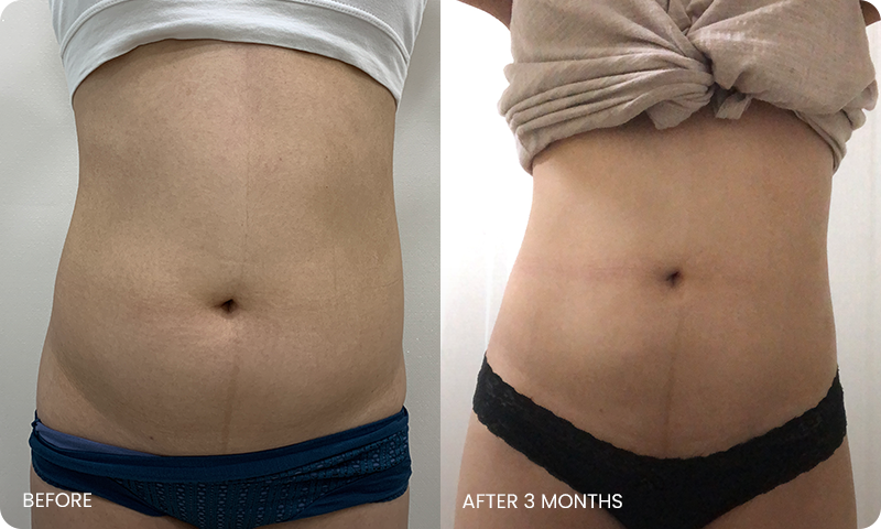 abdominal liposuction bna