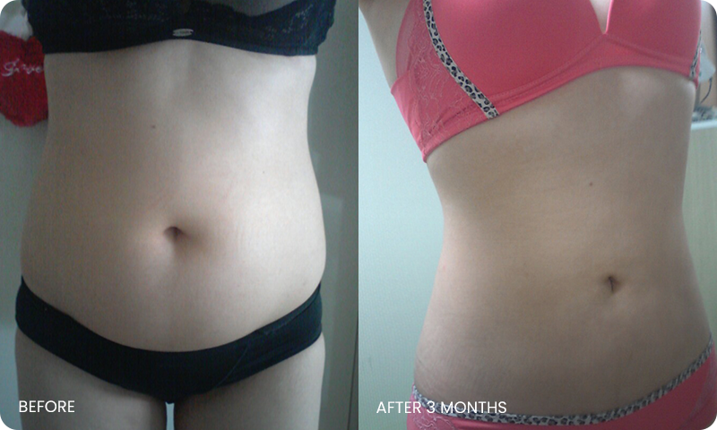 abdominal liposuction bna