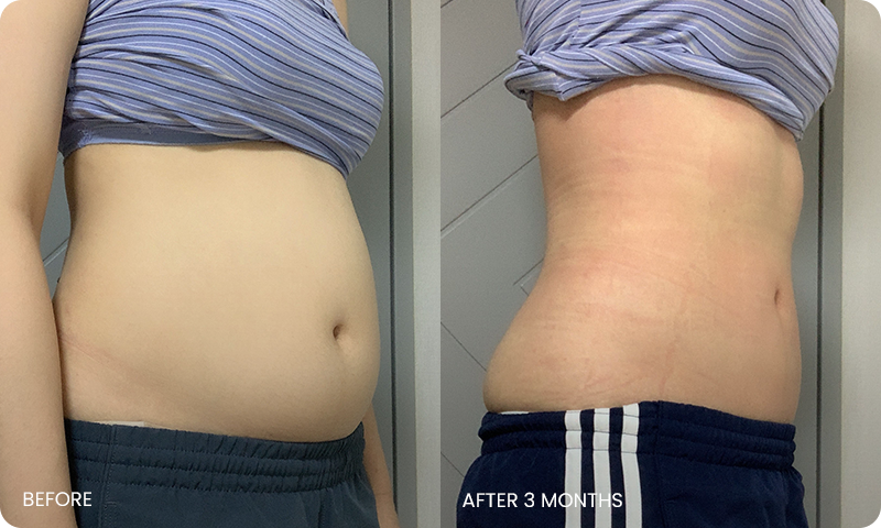 abdominal liposuction bna